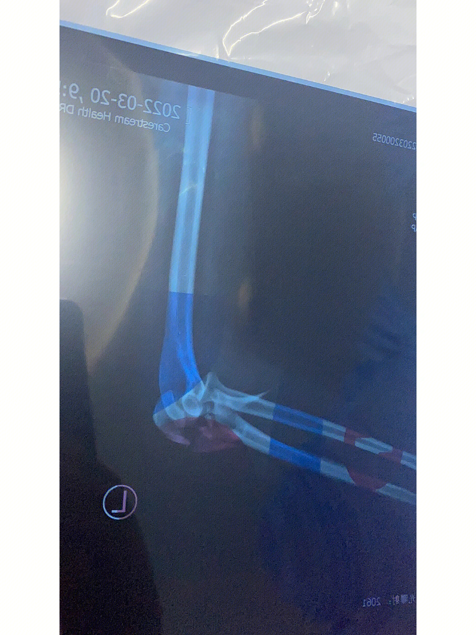 左尺骨近端开放粉碎性骨折4个月恢复中