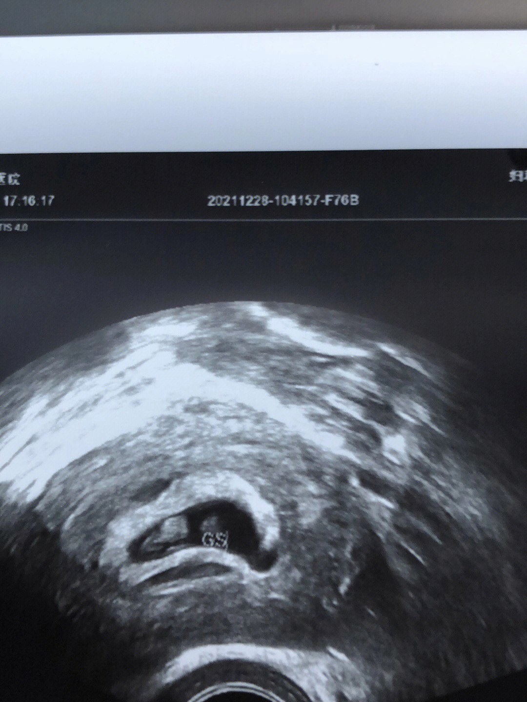 怀孕7周孕囊大小图片图片