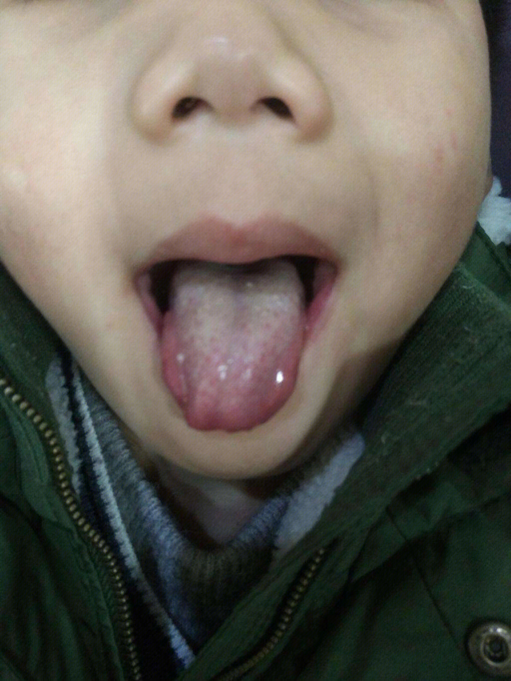 婴儿肺炎嘴唇发青图片图片