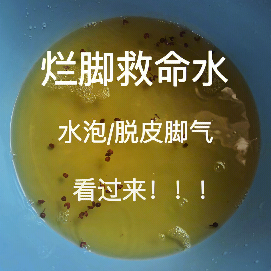 水疱型脚气红肿痒我的救命水