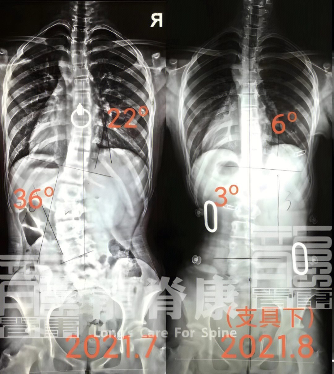 脊柱侧弯矫正3个月剃刀背14度减至0度73