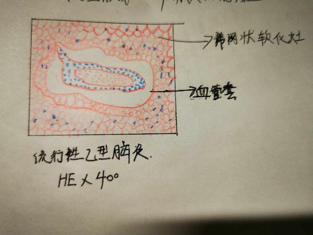 医学生#实验报告#红蓝铅笔绘图#流行性乙型脑炎#流行性化脓性