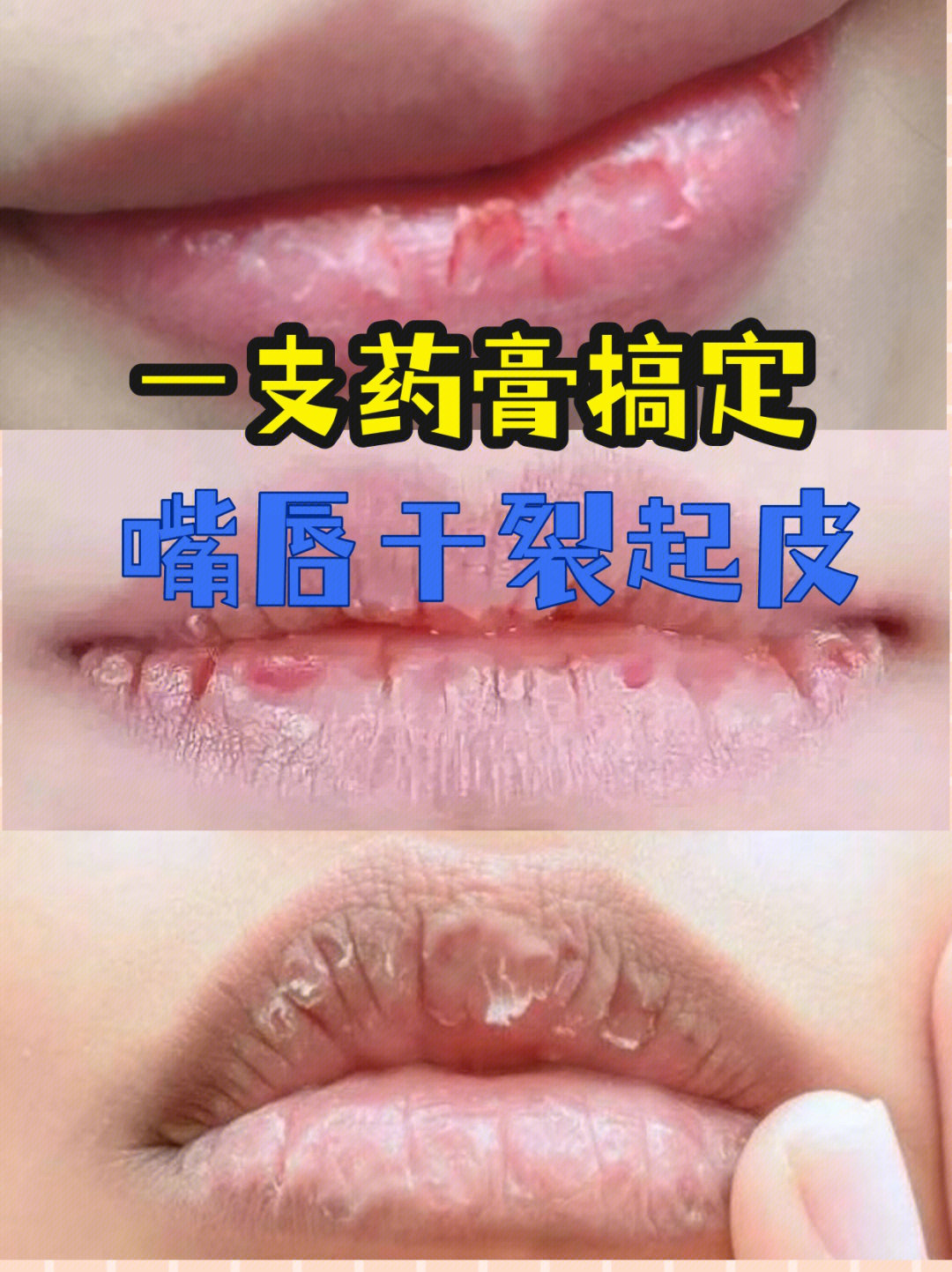 详细科普一下↓98红霉素软膏能解决嘴唇干裂起皮主要是红霉素眼膏里