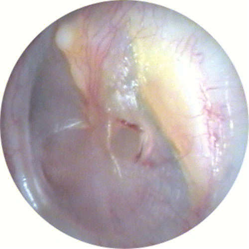 耳膜破了会怎么样图片