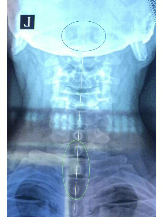 颈椎问题寰枢椎间隙不对称