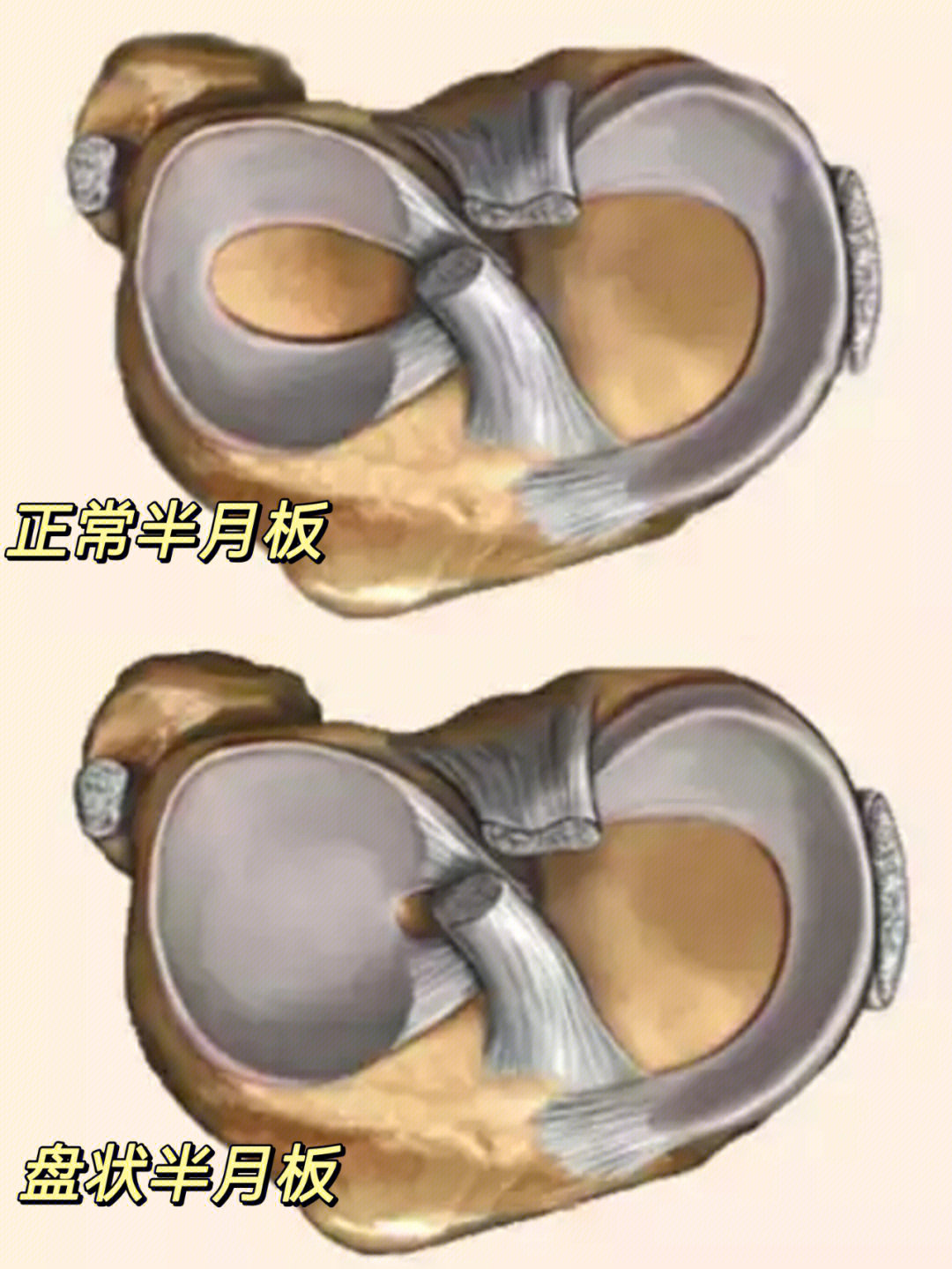 盘状半月板遗传几率图片