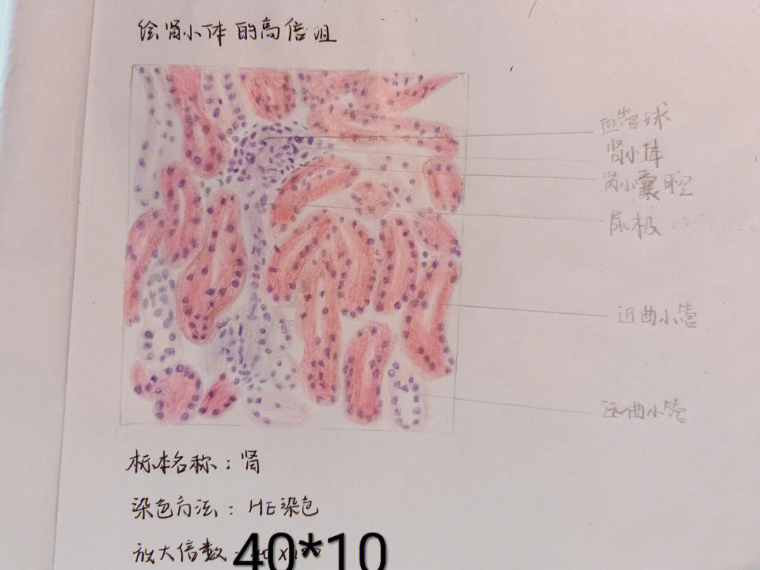 肾颗粒样变性的手绘图图片