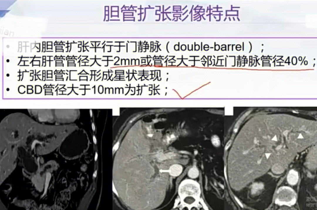 肝内胆管扩张图片