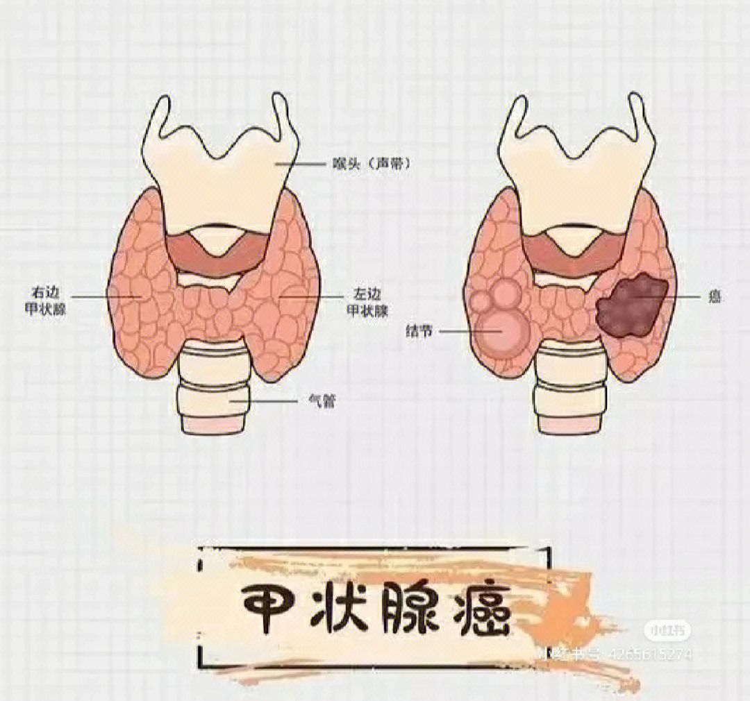 为什么会得甲状腺癌图片