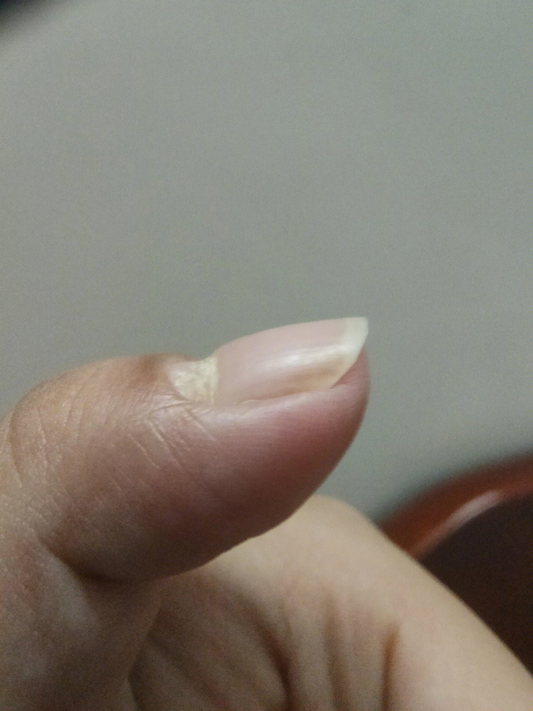 大拇指指甲凹陷一个坑图片