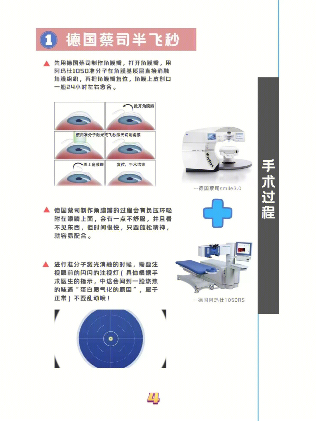 近视手术过程图片