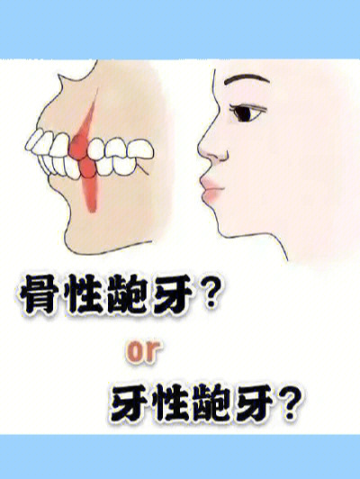 如何区分龅牙是骨性还是牙性参考这三点