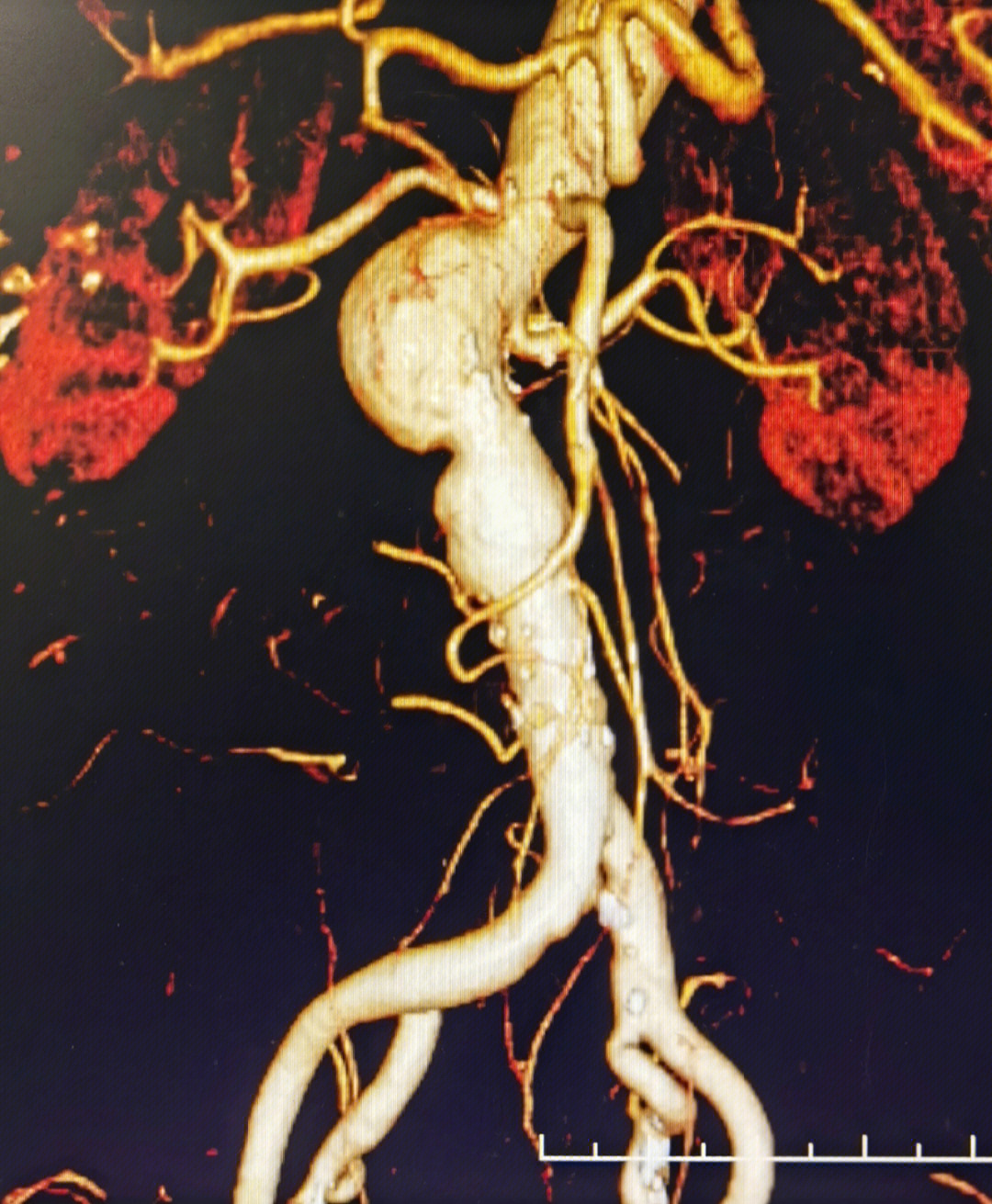 腹主动脉瘤的症状图片