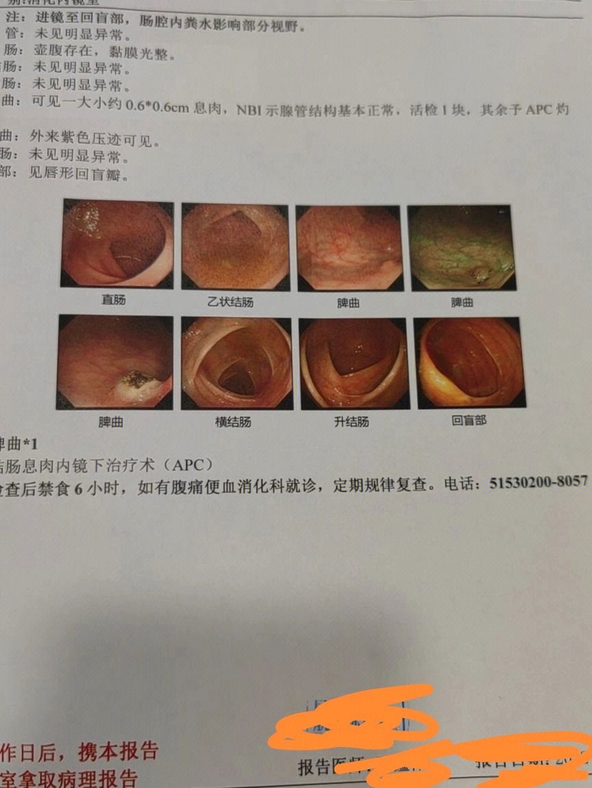 乙状结肠疼痛怎么办图片