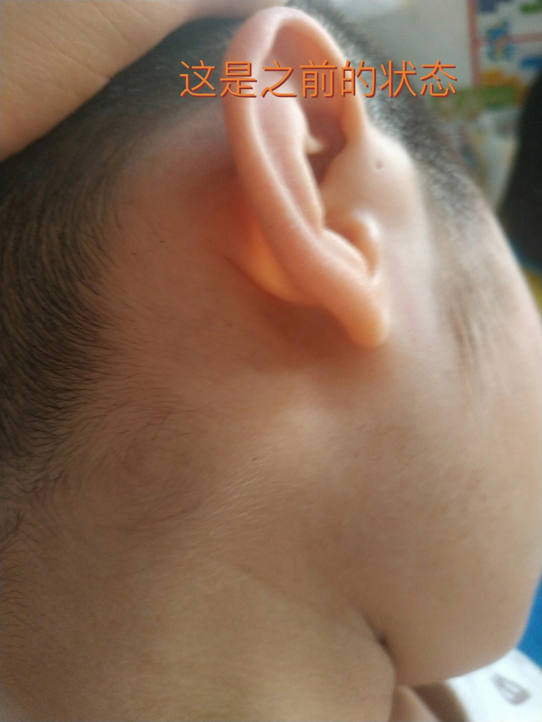 我家宝贝五岁多,之前一直右耳有这个耳前瘘管鼓包,大概维持了有一年多