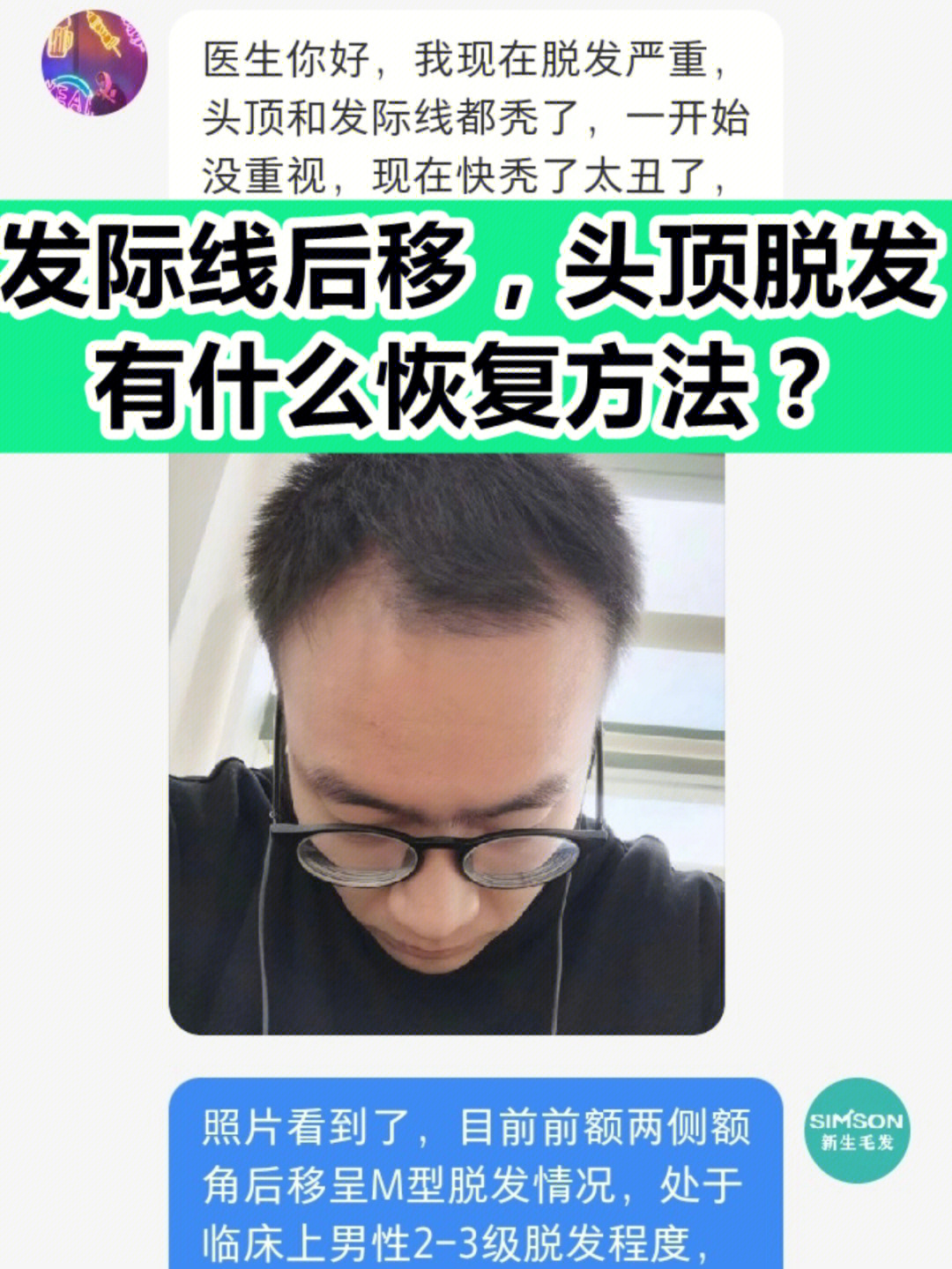 986971发际线后移,头顶脱发恢复方法7115