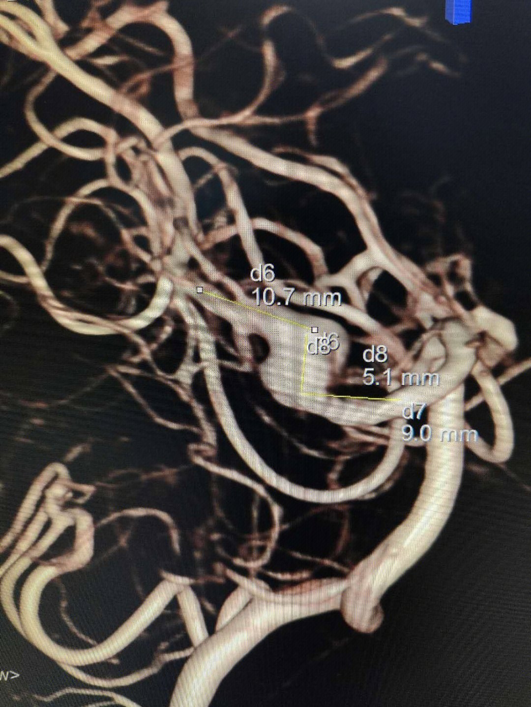 脑动脉瘤夹子型号图片