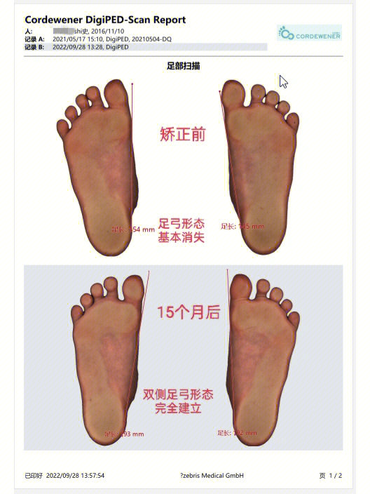 扁平足和足外翻的区别图片