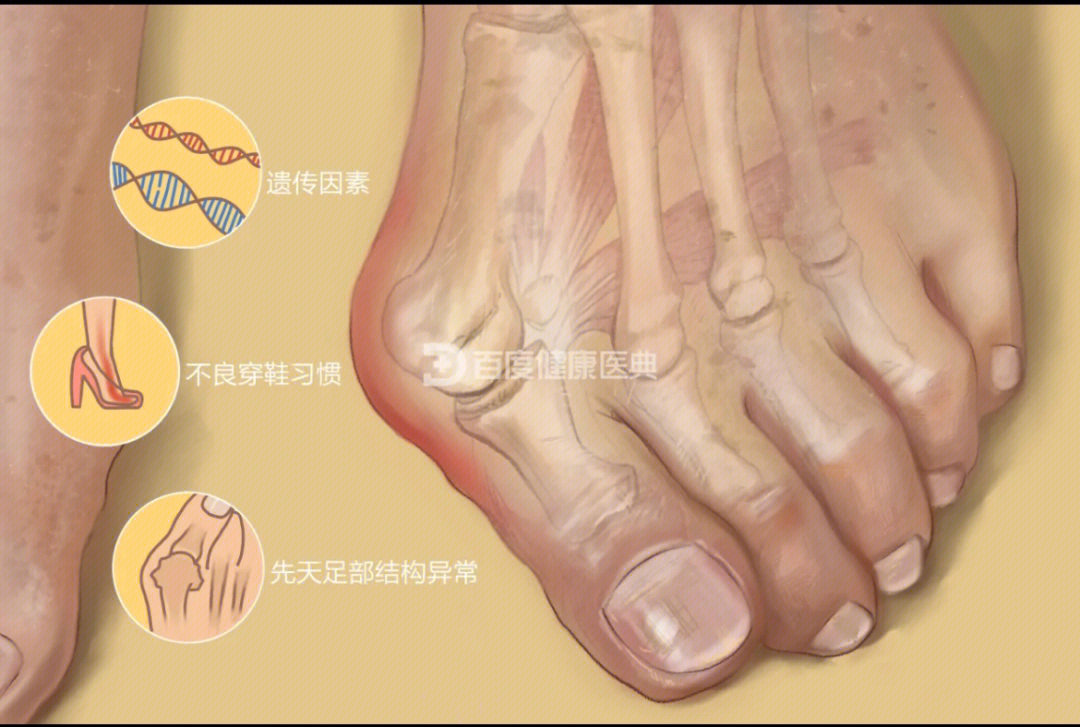 拇指外翻是指构成第一跖趾关节的拇趾向外侧偏斜移位的一种骨骼畸形