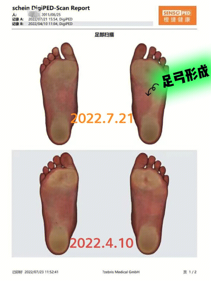 图一:足弓形成明显(右脚最明显)图二:内八度数改善图三:前后足压力