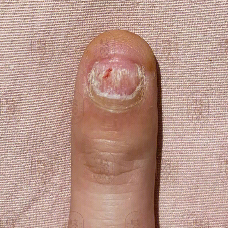灰指甲初期图片 手指图片
