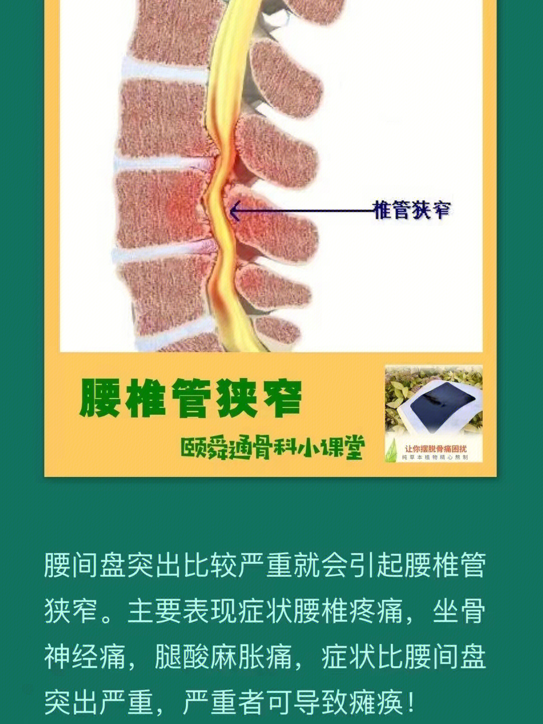 腰椎管狭窄