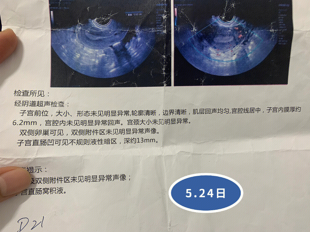 子宫直肠窝无回声区图片