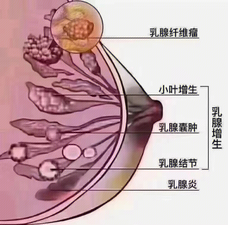 乳腺增生 图片库图片