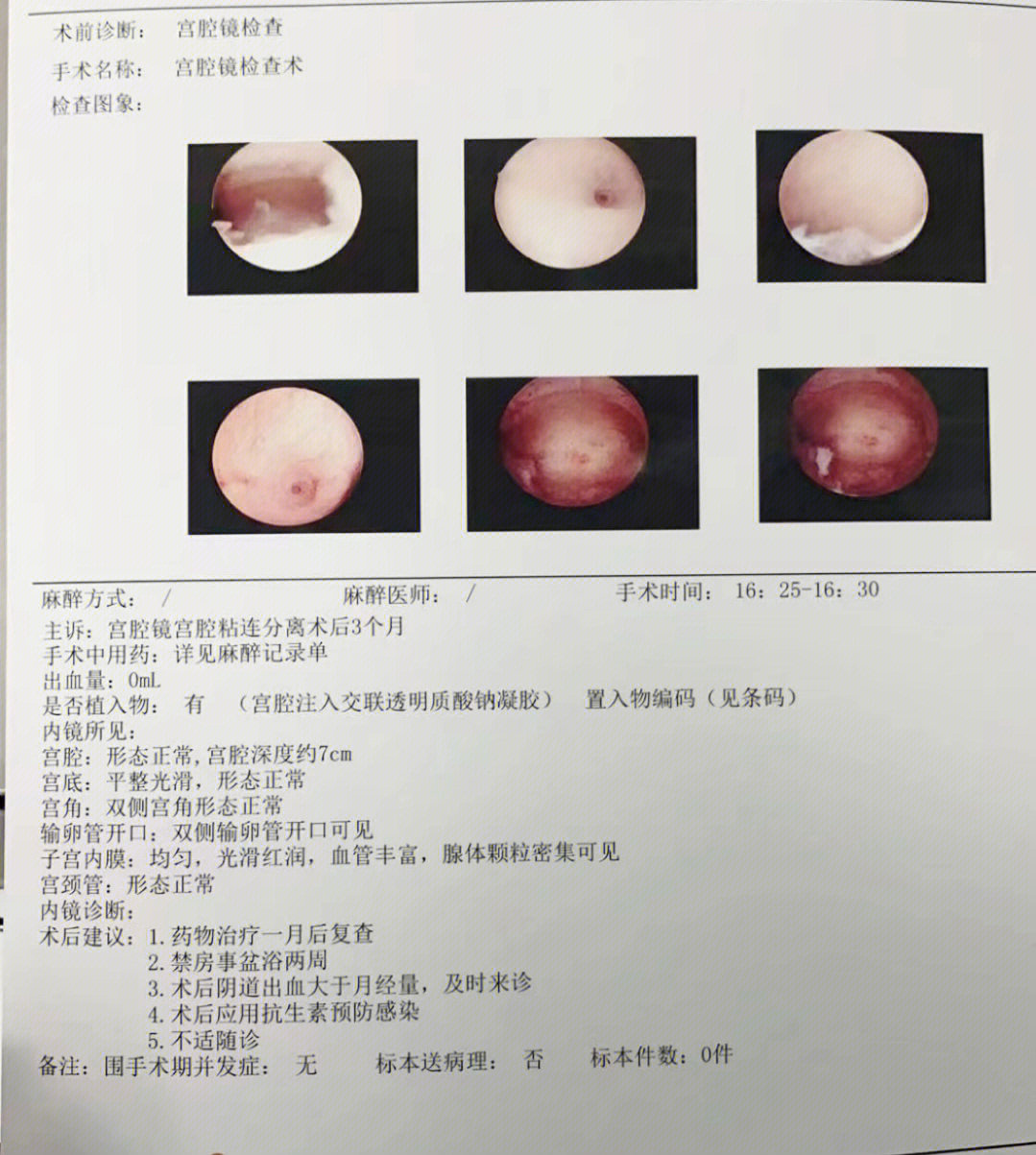 宫腔粘连术后水囊图片图片