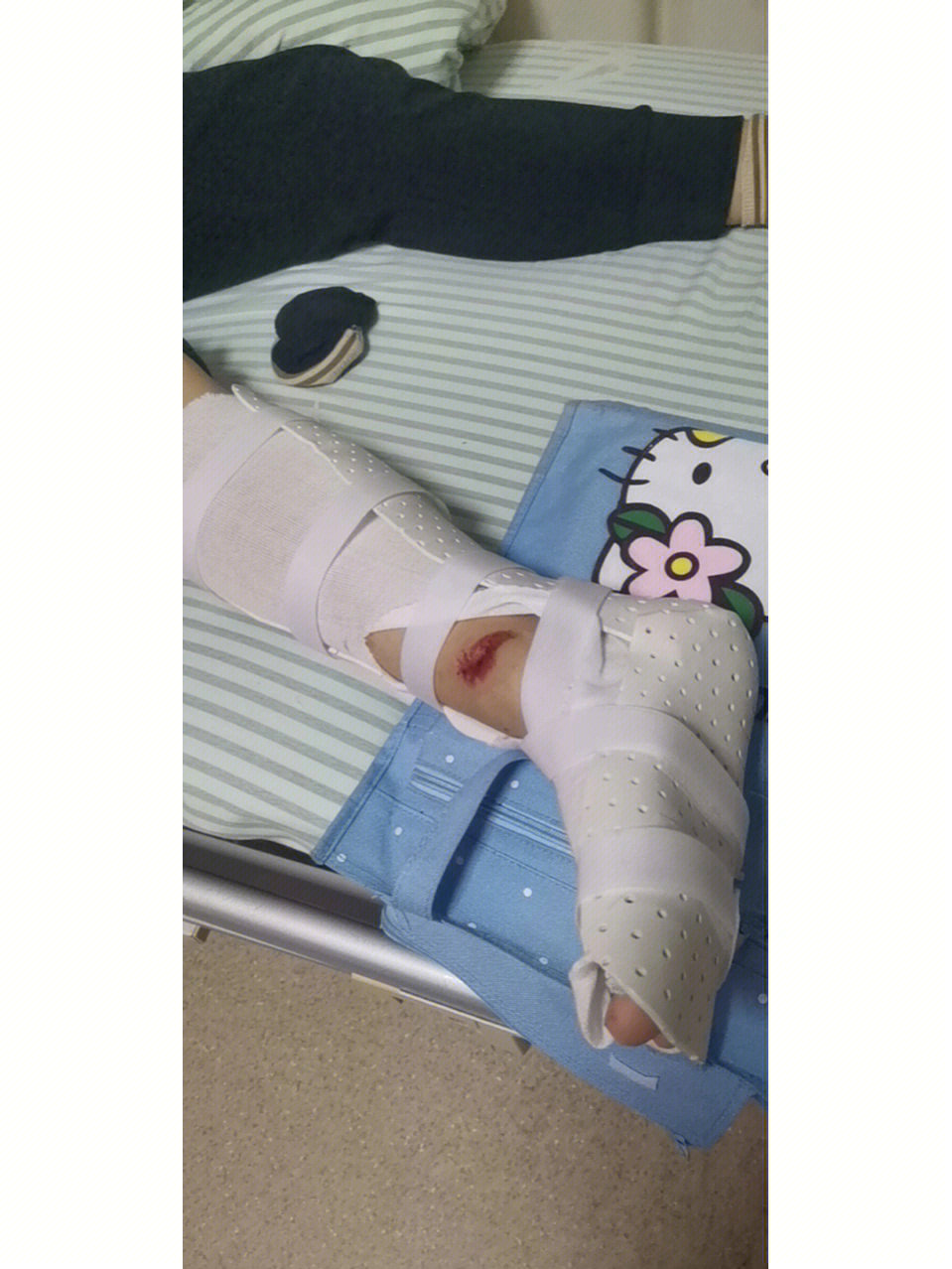 我的脚腕骨折了