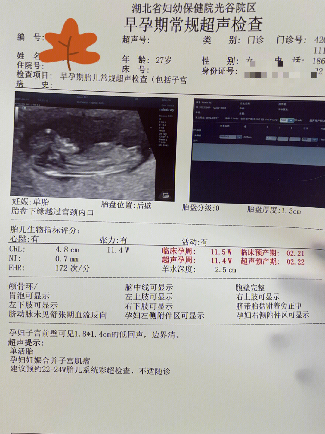 孕11周胎心位置图片图片