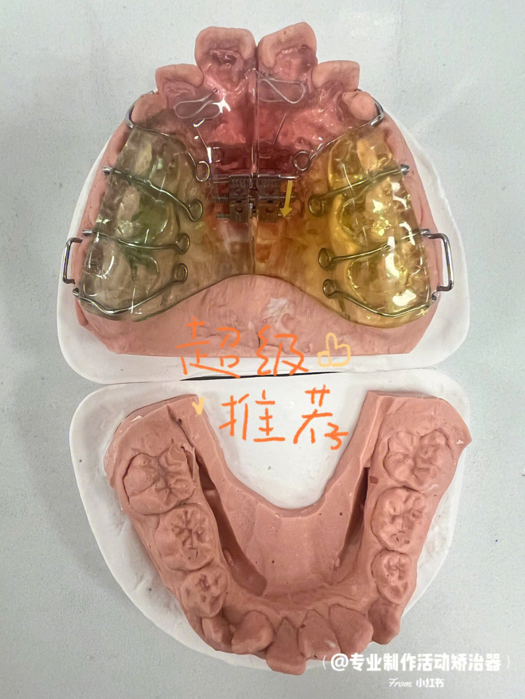 儿童活动矫正器之"螺旋扩弓器"7515