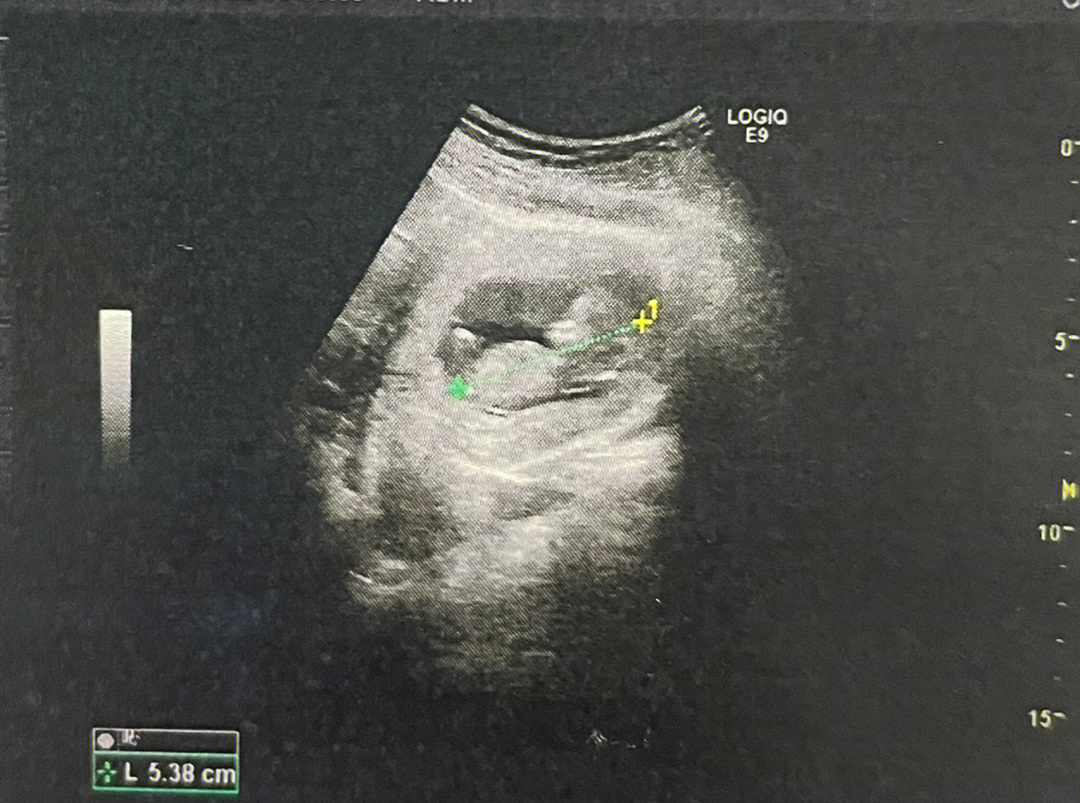 八个月听胎心的位置图图片