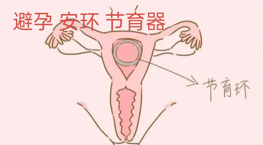 女性避孕环原理图片
