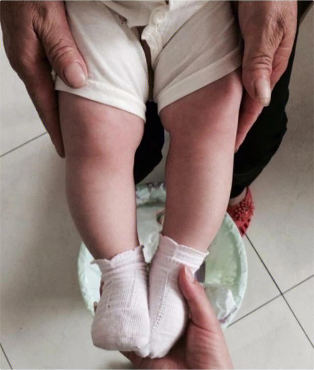 婴幼儿正常腿纹图图片
