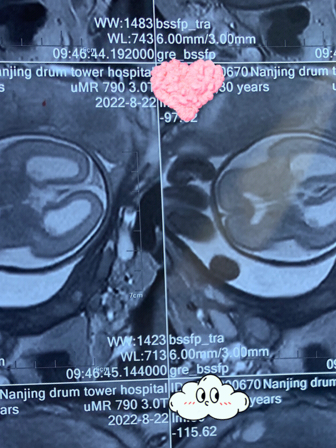 胎儿核磁共振女孩图图片