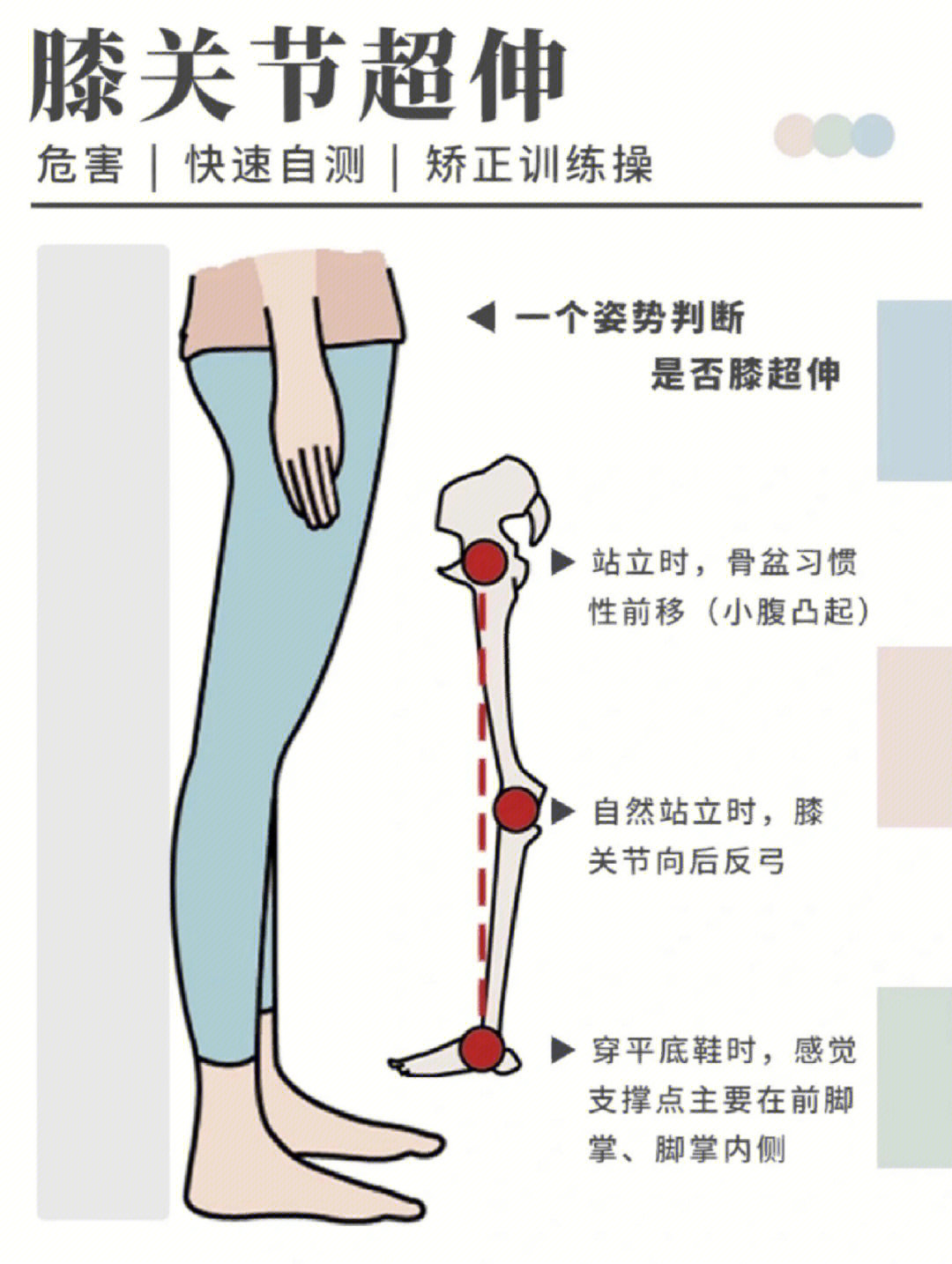 膝盖超伸导致的不良体态