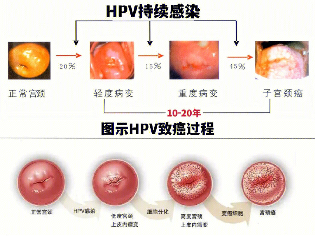 hpv传染性强吗 小红书