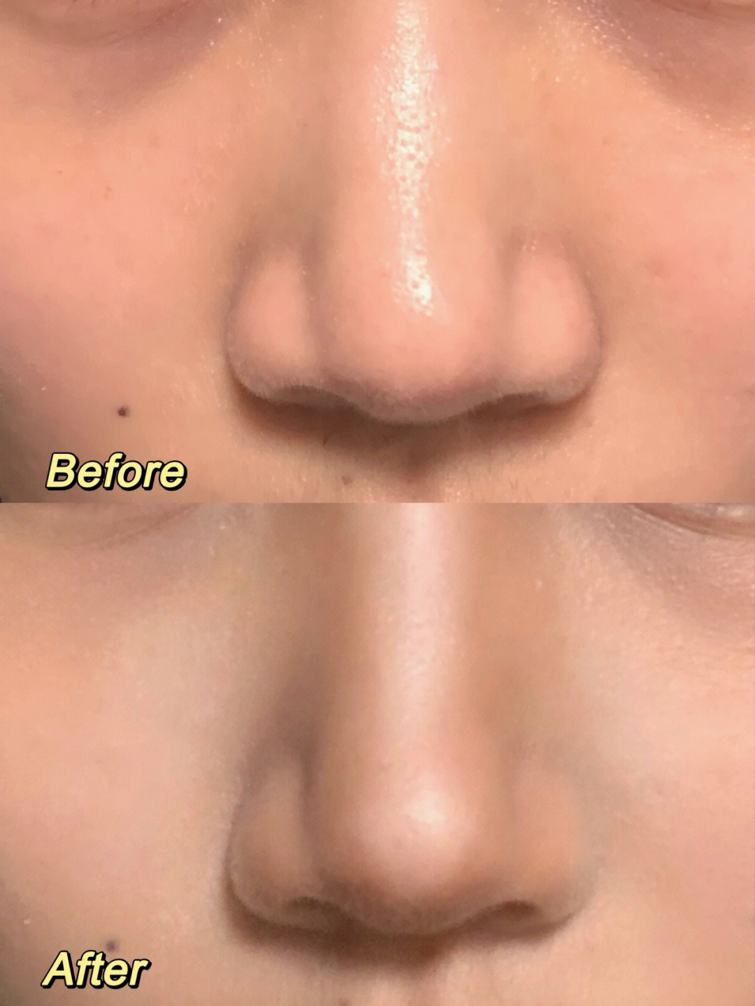 悬胆鼻和蒜头鼻的区别图片