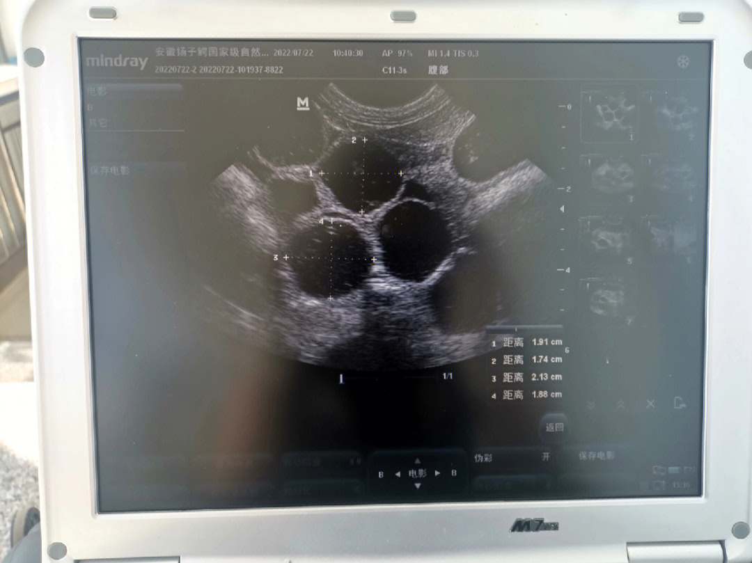 卵丘超声图片图片