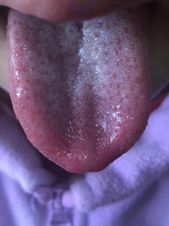 肝胆湿热舌苔表现图图片