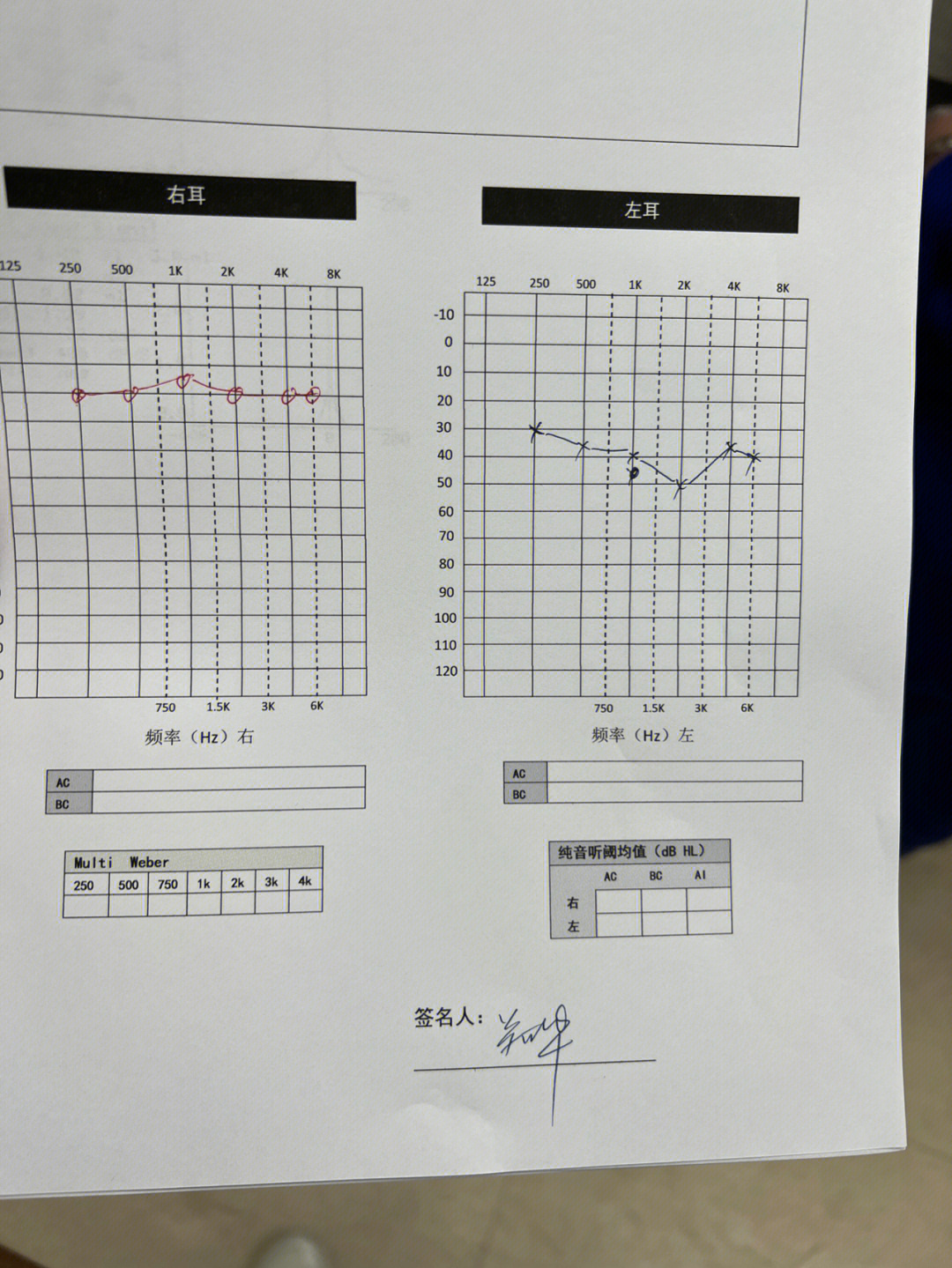 耳硬化症纯音测听图图片