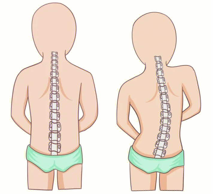 脊柱侧弯一定会影响身体升高,产生的原因有脊柱侧弯是先天性发育的