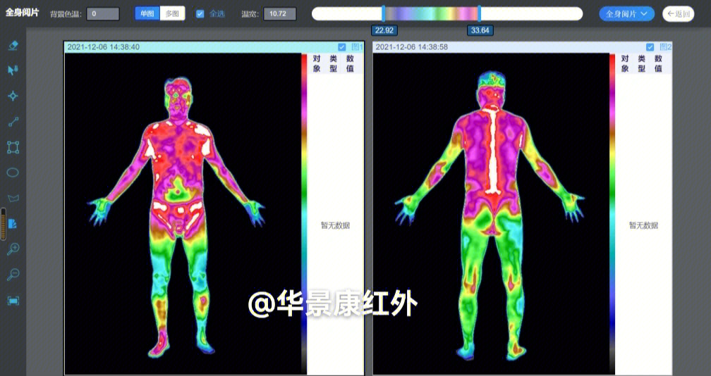 数字式医用远红外热成像ct热图像效果展示