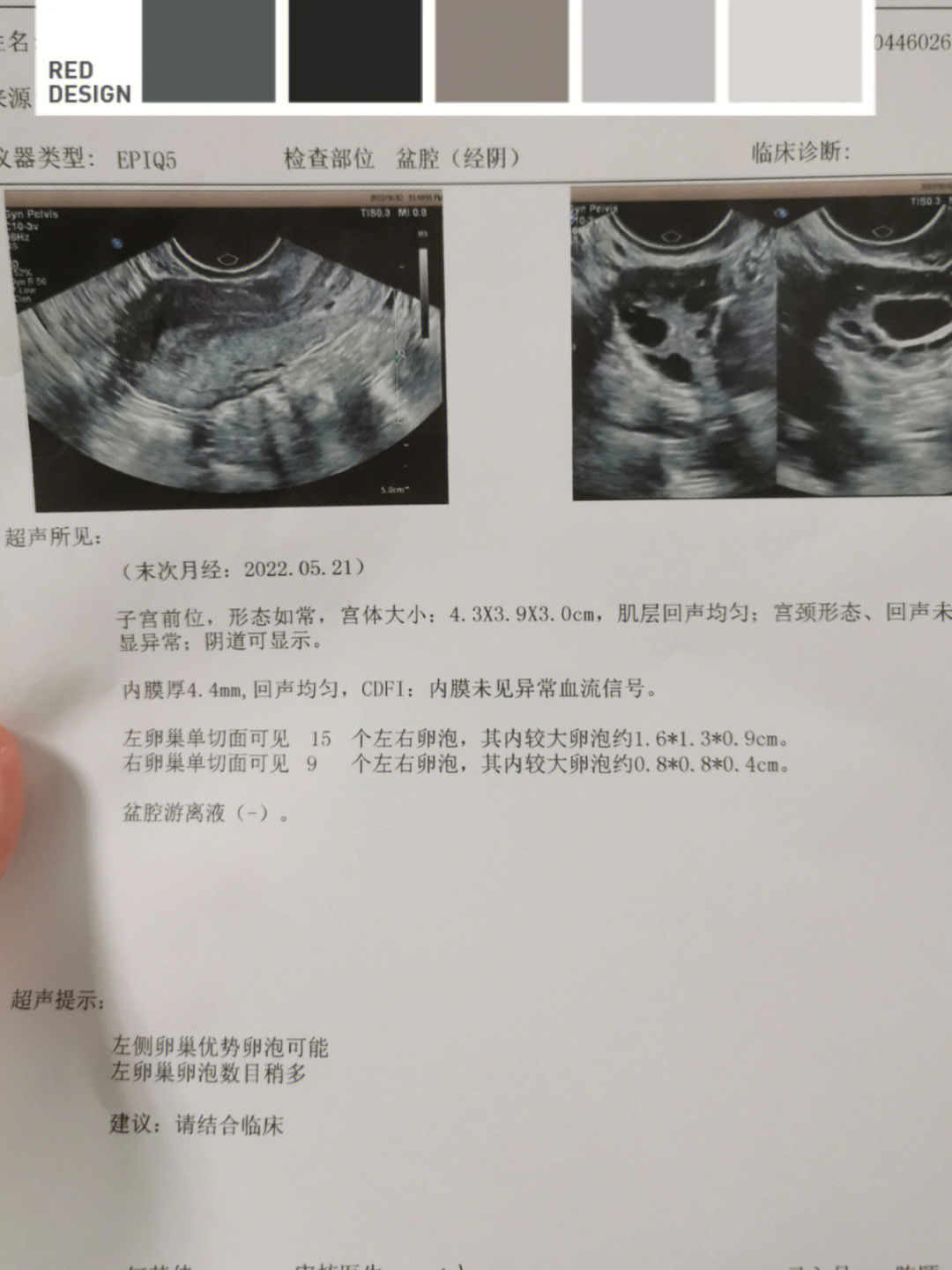 监测卵泡超声报告图片图片