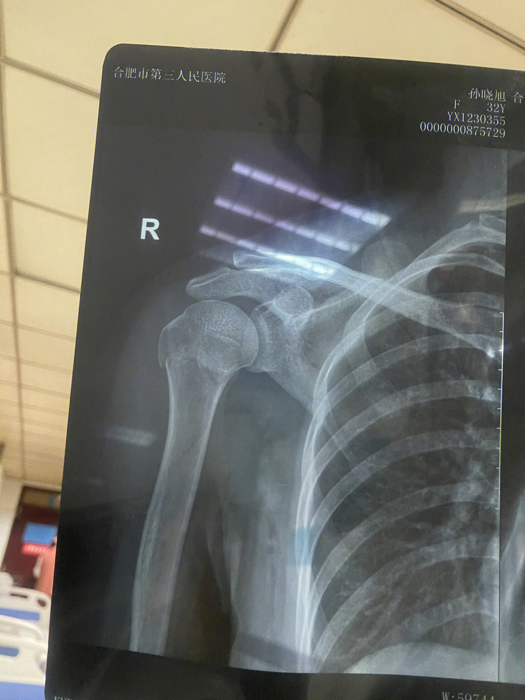 肱骨骨折保守治疗图片