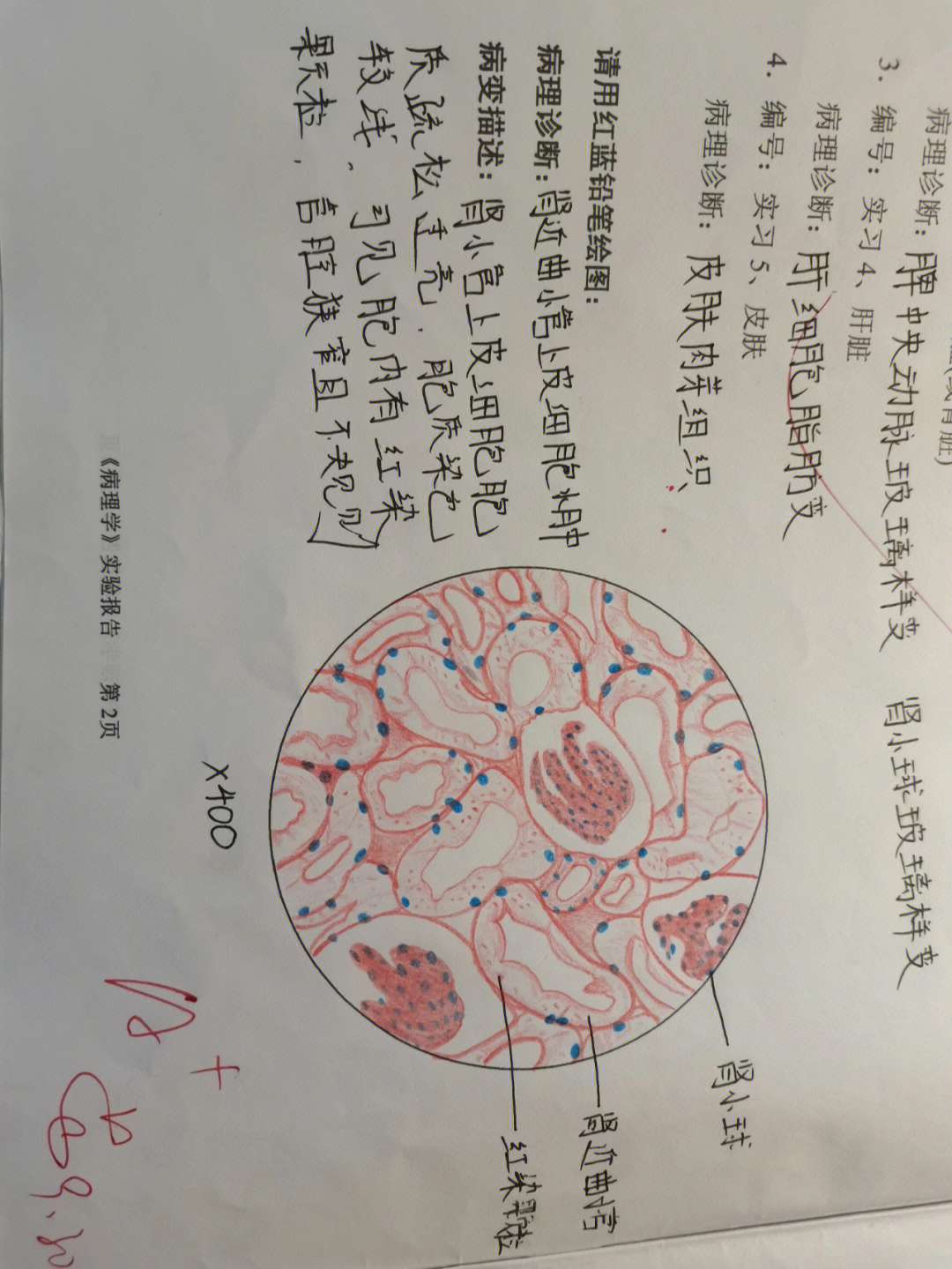 炎性细胞红蓝铅笔图图片