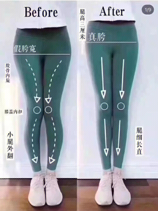 x型腿如何矫正图解图片