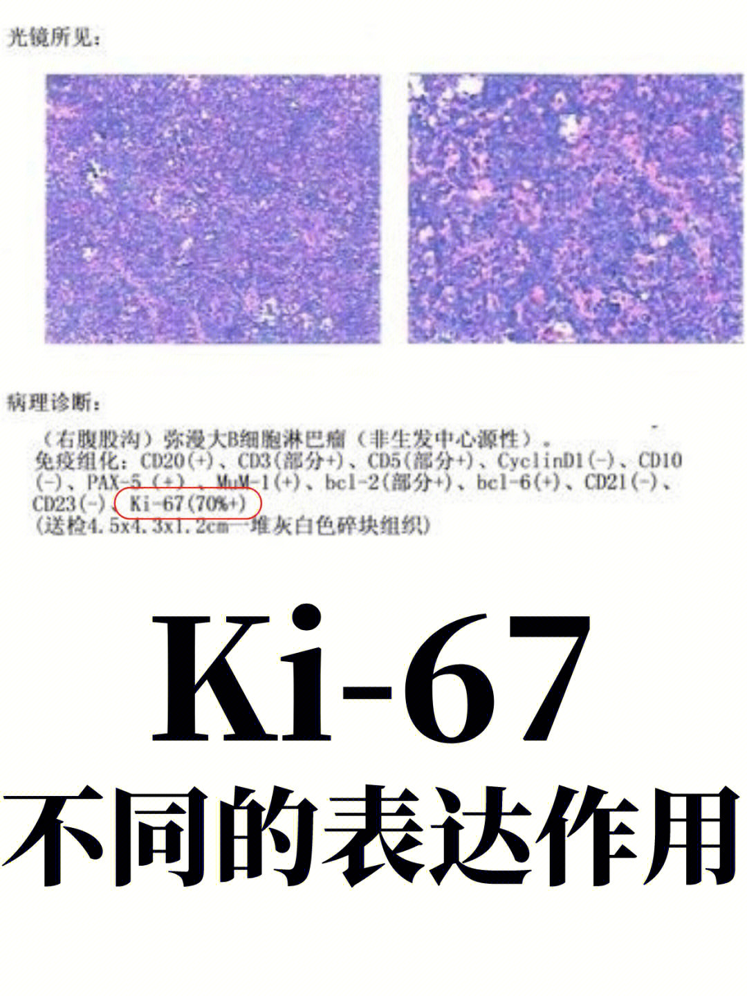 ki67越高预后越不好吗解读病理报告ki67