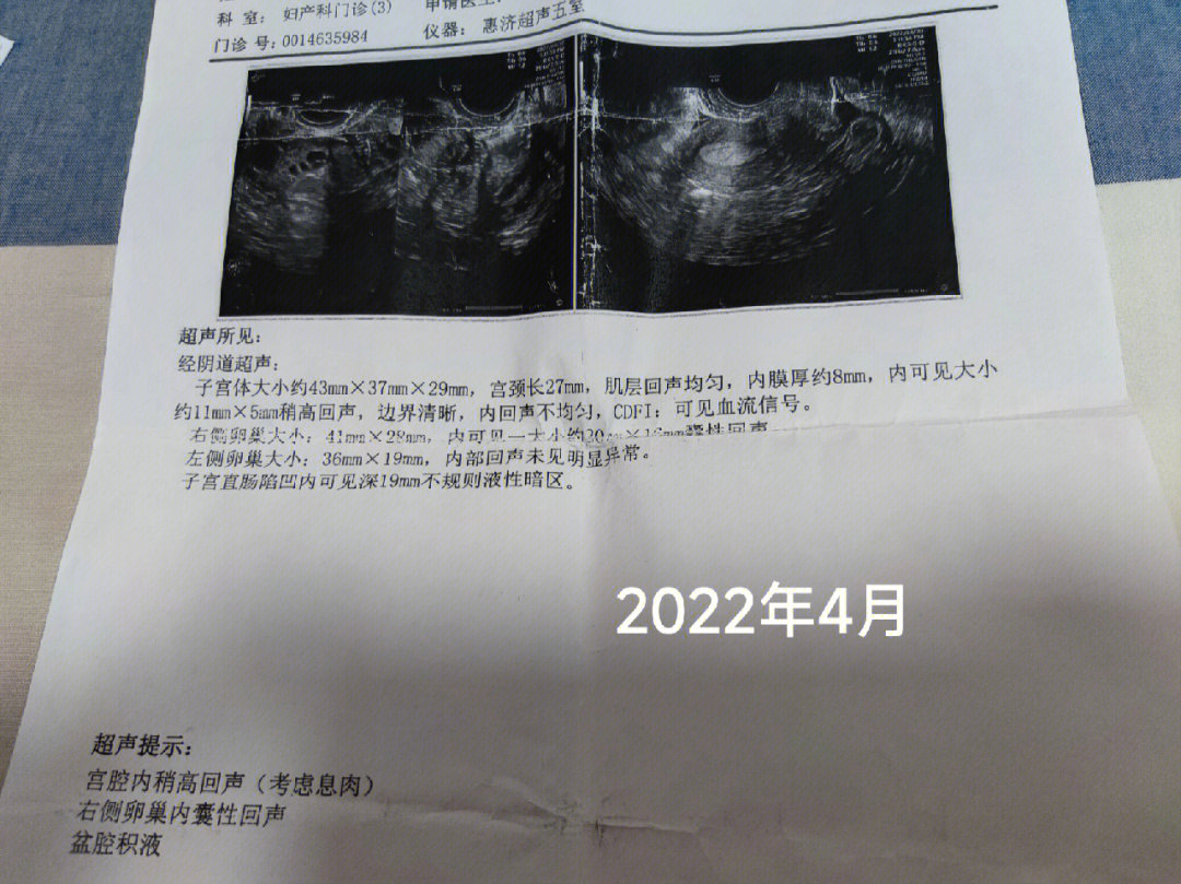 宫颈息肉病理报告图片